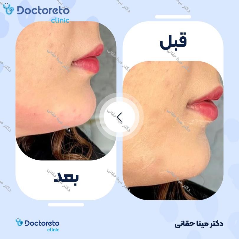 تزریق ژل چانه با برند نئوویا (1CC)