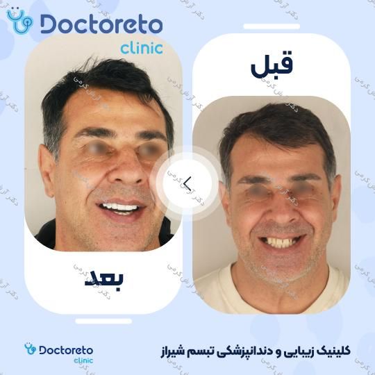 ایمپلنت دیجیتال دنتیس کره ای با روکش (هر واحد) دکتر آرش کرمی در شیراز 21