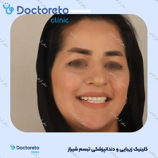 ایمپلنت دیجیتال dio کره ای با روکش (هر واحد) دکتر آرش کرمی در شیراز 93