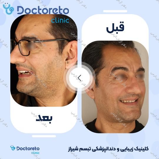 ایمپلنت دیجیتال دنتیس کره ای با روکش (هر واحد) دکتر آرش کرمی در شیراز 105