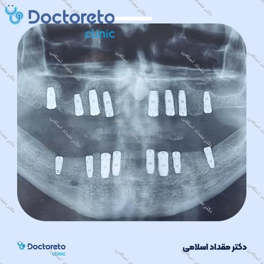 ایمپلنت کره ای ARUM با روکش (هر واحد) دکتر مقداد اسلامی در تهران 10