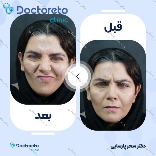 تزریق بوتاکس صورت (پیشانی، خط اخم، دور چشم) با برند دیستون دکتر سحر پارسایی در مشهد 4