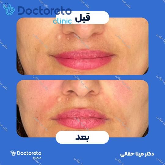 تزریق ژل خط خنده با برند نورافیل (1CC) دکتر مینا حقانی در اصفهان 2