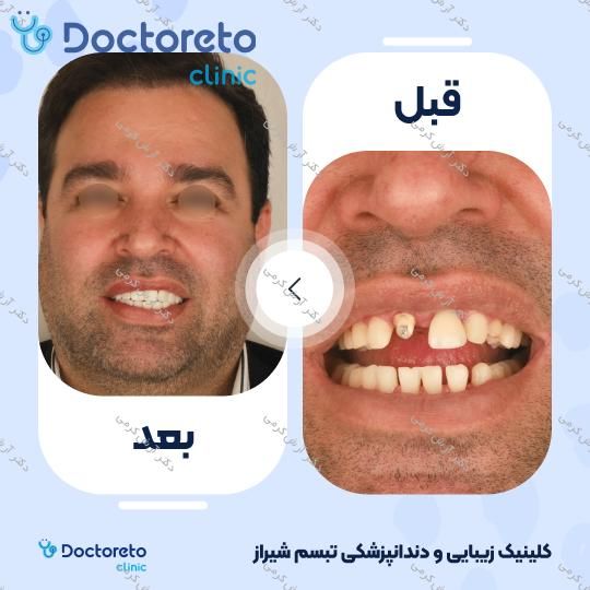 ایمپلنت دیجیتال دنتیس کره ای با روکش (هر واحد) دکتر آرش کرمی در شیراز 31