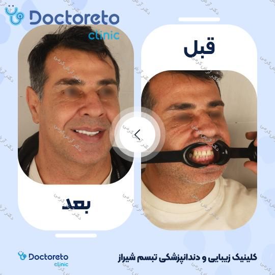 ایمپلنت دیجیتال دنتیس کره ای بدون روکش (هر واحد) دکتر آرش کرمی در شیراز 14