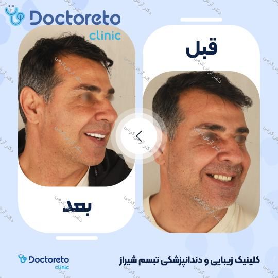 ایمپلنت دیجیتال دنتیس کره ای بدون روکش (هر واحد) دکتر آرش کرمی در شیراز 18