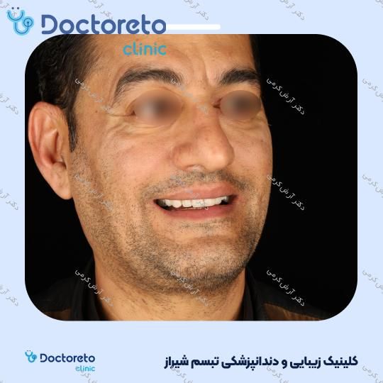 ایمپلنت دیجیتال dio کره ای با روکش (هر واحد) دکتر آرش کرمی در شیراز 97