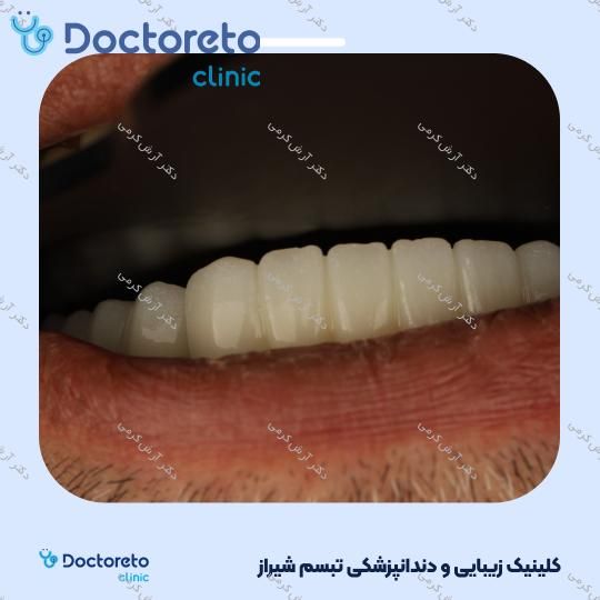 ایمپلنت دیجیتال اشترومن سوئیسی نئودنت بدون روکش (هر واحد) دکتر آرش کرمی در شیراز 108