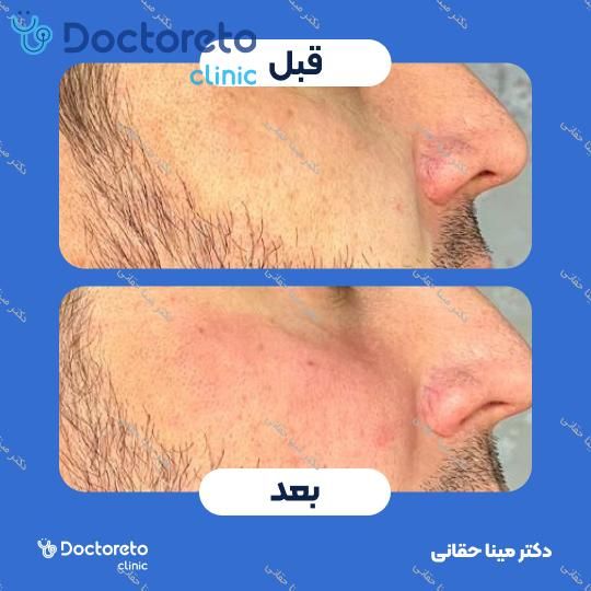 تزریق ژل گونه با برند نورافیل (1CC) دکتر مینا حقانی در اصفهان 3