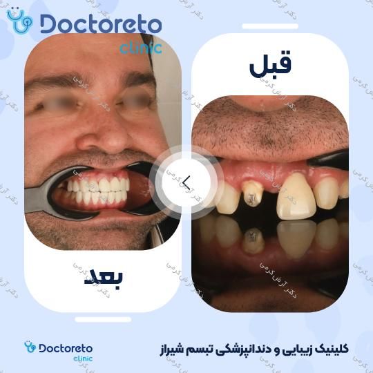 ایمپلنت دیجیتال دنتیس کره ای بدون روکش (هر واحد) دکتر آرش کرمی در شیراز 24