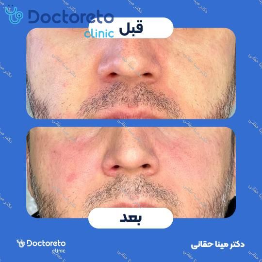 تزریق ژل گونه با برند نئوویا (1CC) دکتر مینا حقانی در اصفهان 3