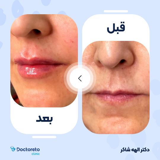 تزریق ژل لب با برند استایلج (1CC)
