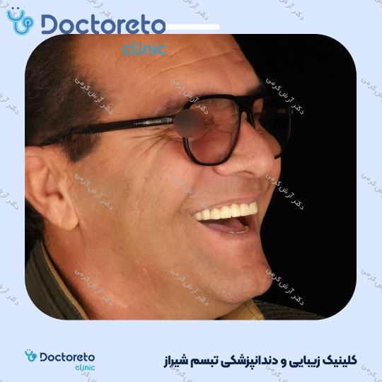 ایمپلنت دیجیتال dio کره ای با روکش (هر واحد) دکتر آرش کرمی در شیراز 61