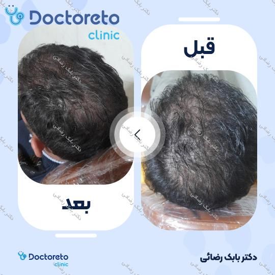 مزوتراپی موی سر با برند رویتاکر (هر جلسه) دکتر بابک رضائی در مهران 4