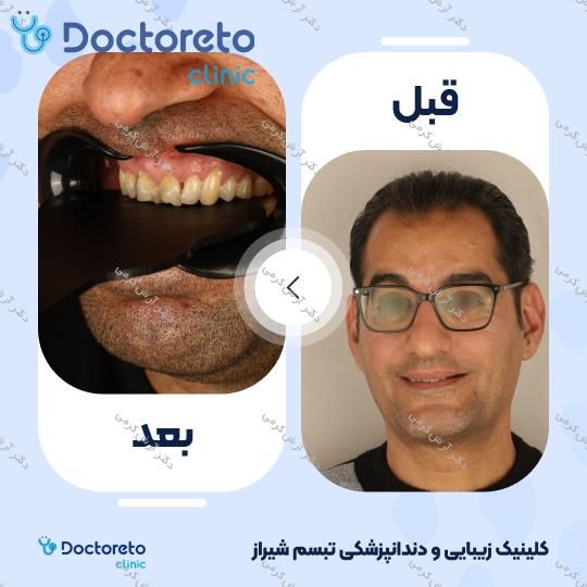 ایمپلنت دیجیتال دنتیس کره ای با روکش (هر واحد) دکتر آرش کرمی در شیراز 110