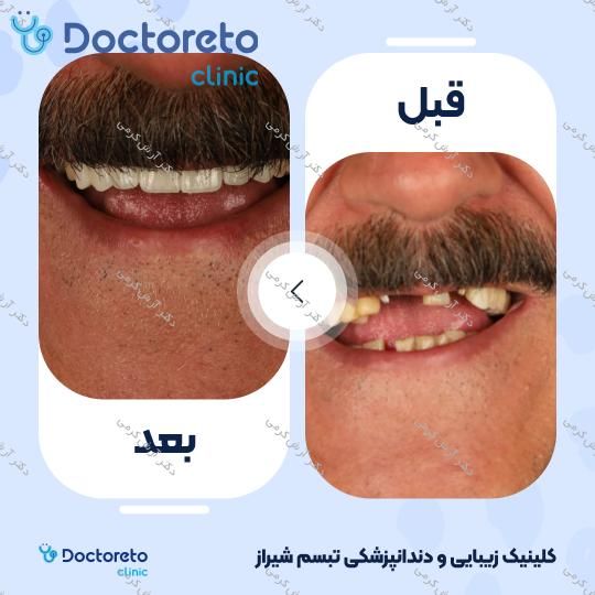 ایمپلنت دیجیتال dio کره ای با روکش (هر واحد) دکتر آرش کرمی در شیراز 49