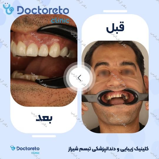 ایمپلنت دیجیتال dio کره ای با روکش (هر واحد) دکتر آرش کرمی در شیراز 103