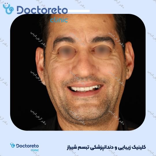 ایمپلنت دیجیتال دنتیس کره ای با روکش (هر واحد) دکتر آرش کرمی در شیراز 100