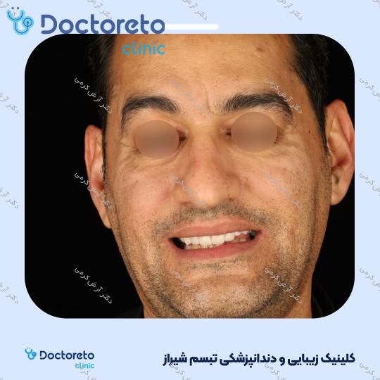 ایمپلنت دیجیتال dio کره ای با روکش (هر واحد) دکتر آرش کرمی در شیراز 100