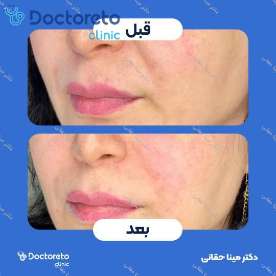 تزریق ژل خط خنده با برند درمال استایل (1CC) دکتر مینا حقانی در اصفهان 3