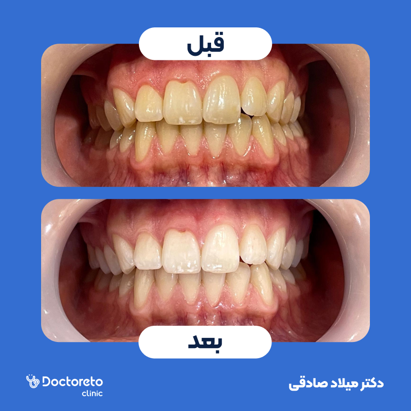 آفیس بلیچینگ (سفید کردن دندان) دو فک با ماده آلمانی دکتر میلاد صادقی در تهران 4