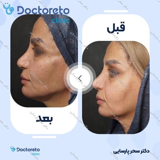 تزریق ژل شقیقه با برند اینووسنس (1CC) دکتر سحر پارسایی در مشهد 2