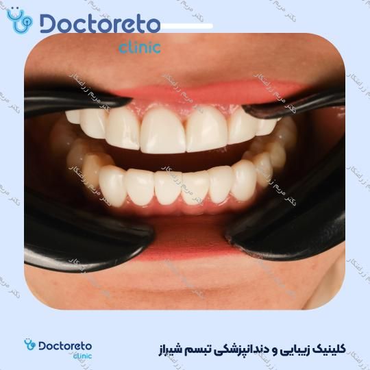 ونیر کامپوزیت توکویاما ژاپنی (هر واحد) دکتر مریم زراعتکار در شیراز 3