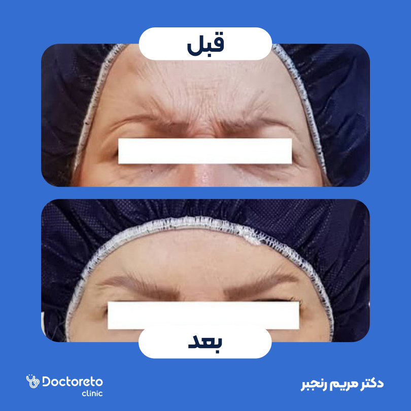 تزریق بوتاکس صورت (پیشانی، خط اخم، دور چشم) با برند دیستون