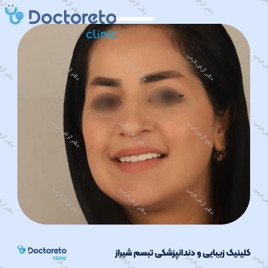 ایمپلنت دیجیتال dio کره ای با روکش (هر واحد) دکتر آرش کرمی در شیراز 96