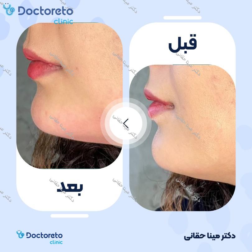 تزریق ژل چانه با برند بلوترو (1CC)