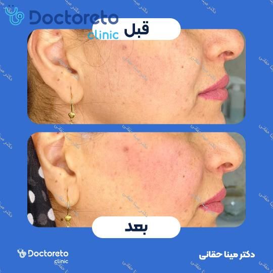 تزریق ژل گونه با برند رووفیل (1CC) دکتر مینا حقانی در اصفهان 5