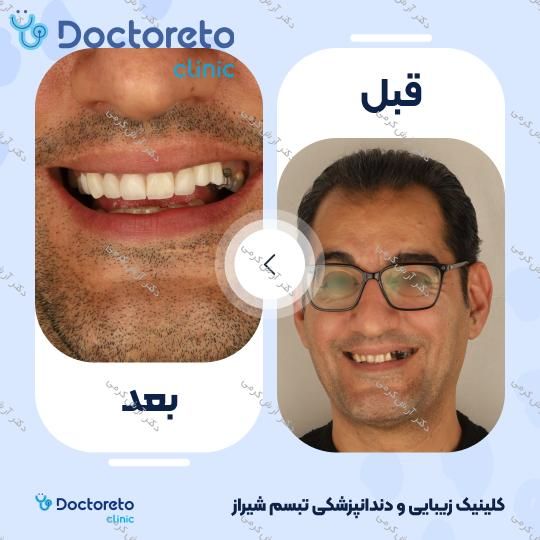 ایمپلنت دیجیتال dio کره ای با روکش (هر واحد) دکتر آرش کرمی در شیراز 105