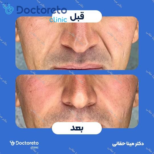 تزریق ژل گونه با برند بلوترو (1CC) دکتر مینا حقانی در اصفهان 6