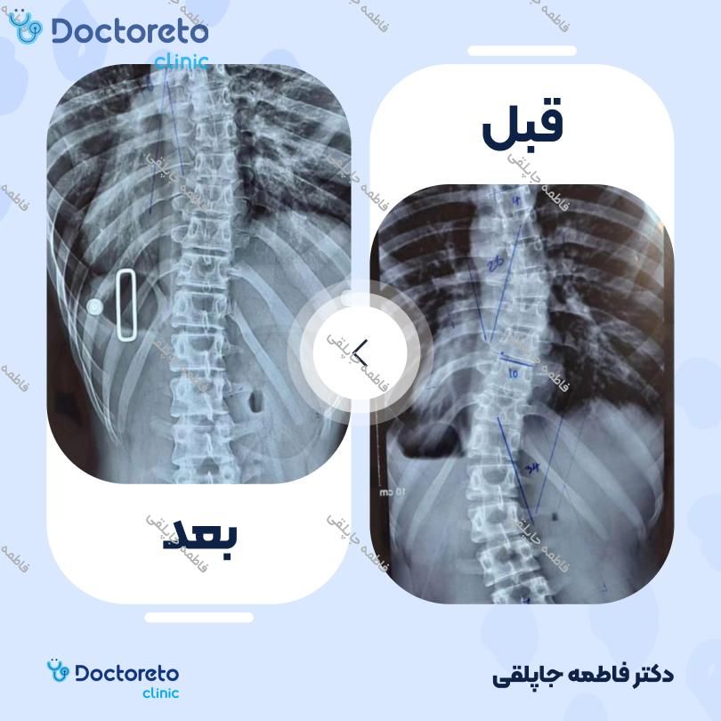 درمان انحراف اسکولیوز با کمربند طبی فاطمه جاپلقی در تهران 2