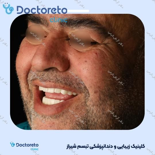 ایمپلنت دیجیتال dio کره ای با روکش (هر واحد) دکتر آرش کرمی در شیراز 121