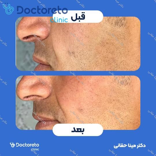 تزریق ژل گونه با برند نئوویا (1CC) دکتر مینا حقانی در اصفهان 7