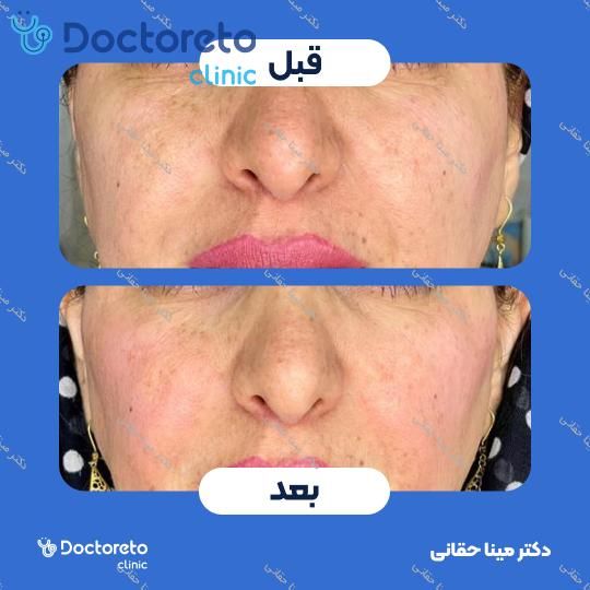 تزریق ژل گونه با برند بلوترو (1CC) دکتر مینا حقانی در اصفهان 8