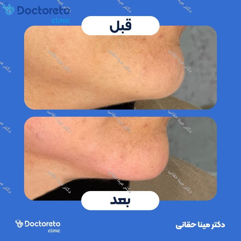 تزریق ژل چانه با برند آلکاریسا (1CC) دکتر مینا حقانی در اصفهان 3