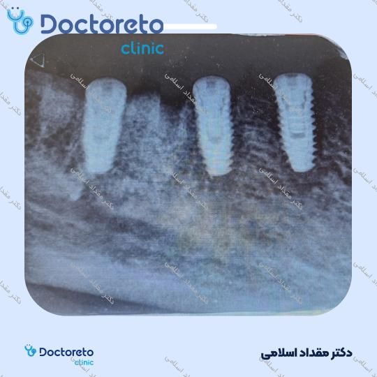 ایمپلنت اشترومن سوئیسی تیتانیوم با روکش ( هرواحد ) دکتر مقداد اسلامی در تهران 15