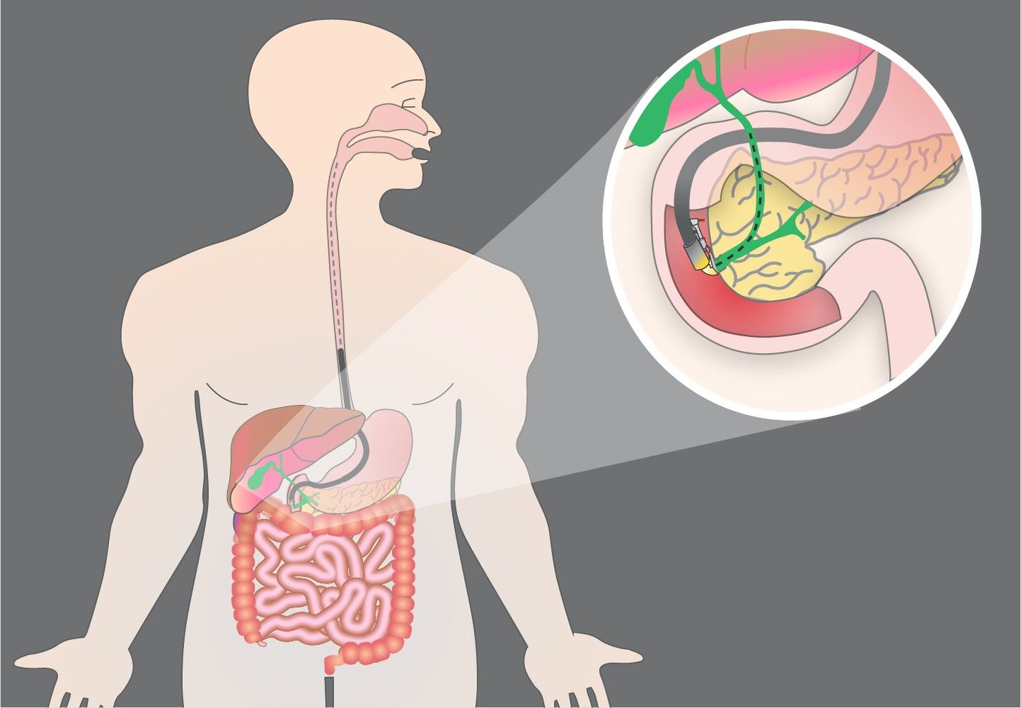 ای آر سی پی تشخیصی و درمانی (ERCP)