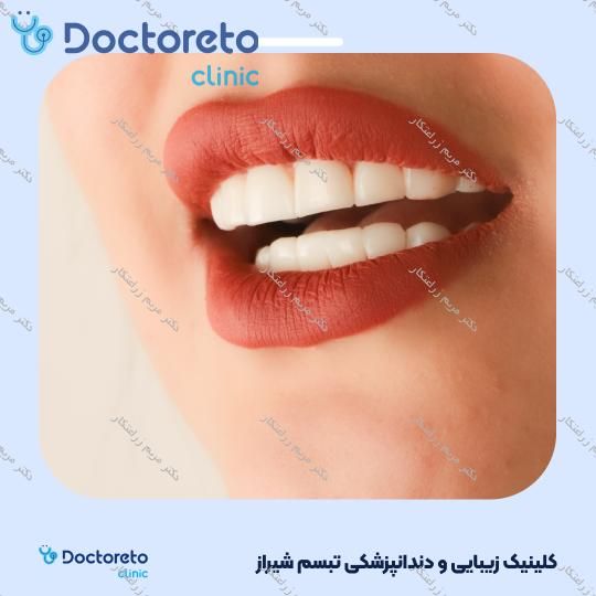 ونیر کامپوزیت توکویاما ژاپنی (هر واحد) دکتر مریم زراعتکار در شیراز 12