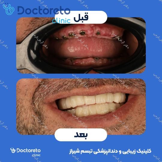 ایمپلنت دیجیتال dio کره ای با روکش (هر واحد) دکتر آرش کرمی در شیراز 131