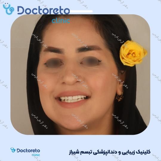 ایمپلنت دیجیتال دنتیس کره ای بدون روکش (هر واحد) دکتر آرش کرمی در شیراز 94