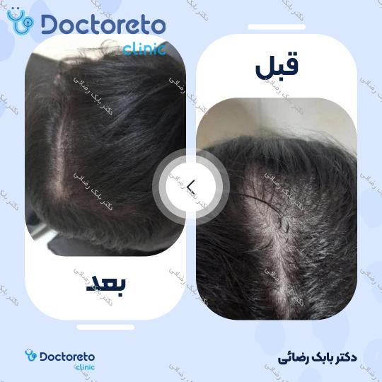 مزوتراپی موی سر با برند فیوژن (هر جلسه)