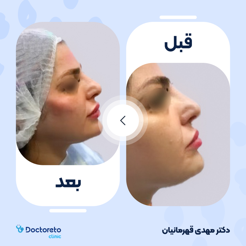 تزریق ژل گونه با برند نورامیس (1cc)