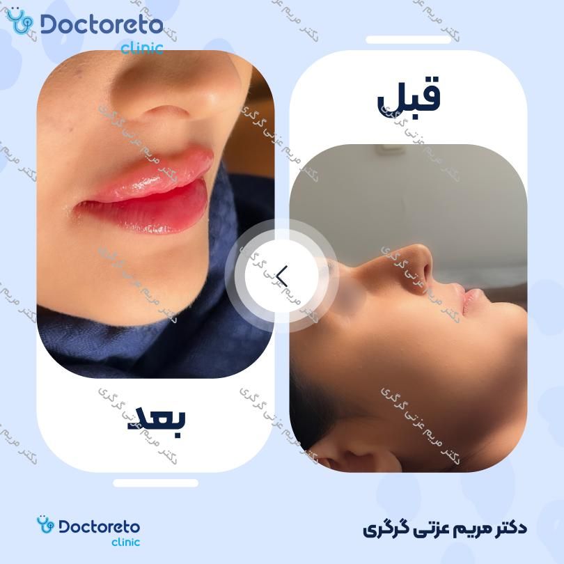 تزریق ژل لب با برند اینووسنس (1CC) دکتر مریم عزتی گرگری در تهران 2