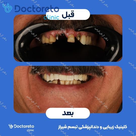 ایمپلنت دیجیتال دنتیس کره ای با روکش (هر واحد) دکتر آرش کرمی در شیراز 45