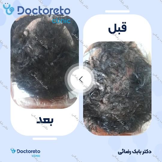 مزوتراپی موی سر با برند فیوژن (هر جلسه) دکتر بابک رضائی در مهران 2