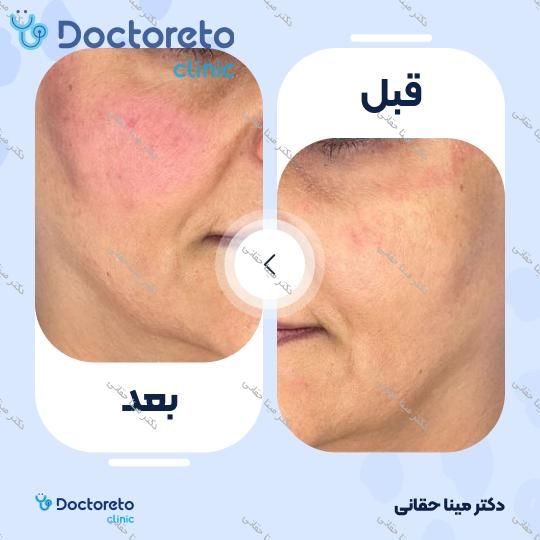 تزریق ژل گونه با برند نورافیل (1CC) دکتر مینا حقانی در اصفهان 6