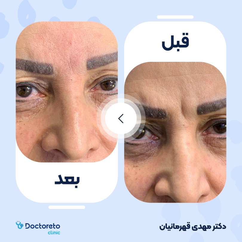 تزریق بوتاکس صورت (پیشانی، خط اخم، دور چشم) با برند درماتوکس